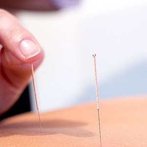 Acupuncture at Axis